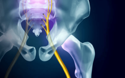 What Is Sciatica & How Can You Solve It?